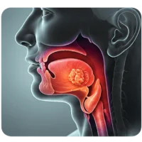 Oral Cavity and Mouth Cancer Surgery in Varanasi - Dr Atul Kumar Rai