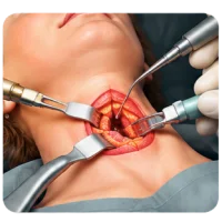 Radical and Selective Neck Node Dissection Surgery Varanasi