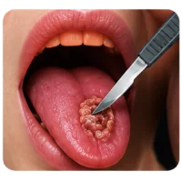 Tongue Cancer Excision and Reconstruction Surgery in Varanasi